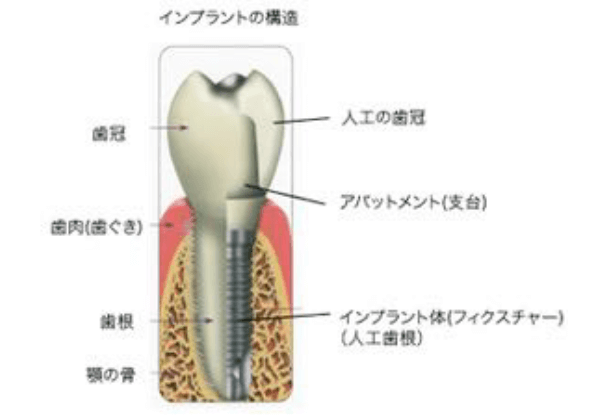 インプラント2